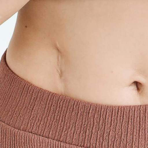 Manualna mobilizacja blizny